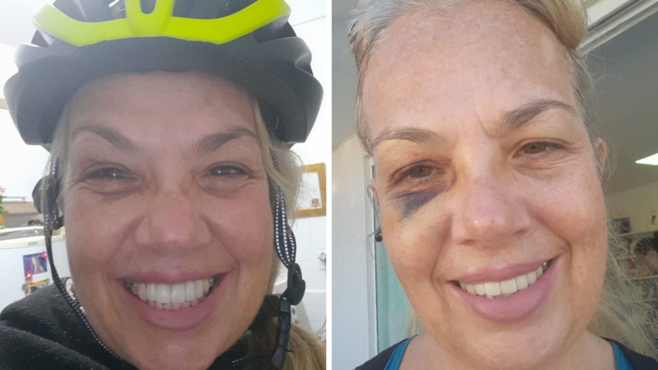 Jaqueline agora (foto à esq.), já recuperada do hematoma no rosto. Ela foi atropelada por uma bike elétrica no dia do seu aniversário.Foto: Arquivo pessoal/NDMais